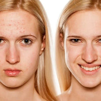 LIROMA GLOW® LED - Lichttherapie Gezichtsmasker met Infrarood & Rood licht - Liroma